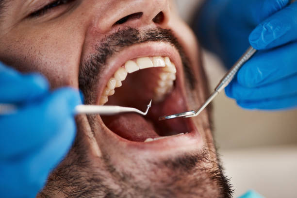 Best Emergency Root Canal Treatment in Allen, TX
